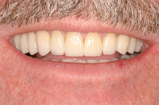 Wadia Dental Group - Full Mouth Reconstruction - After
