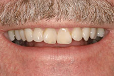 Wadia Dental Group - Full Mouth Reconstruction - Before