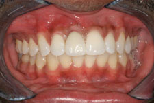 Wadia Dental Group - Single Implant - After