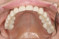 Wadia Dental Group - Upper Bridges - After